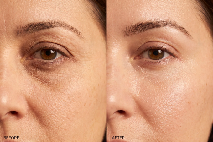 Your Skin Is Losing Volume Faster Than You Realize